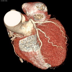 3D-Bild der Herzkranzgefäße